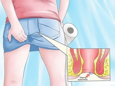 Triệu chứng bệnh trĩ ngoại khi nào cần đi khám ?