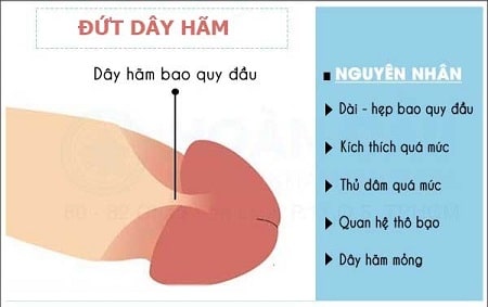 Nguyên nhân gây đứt dây hãm bao quy đầu
