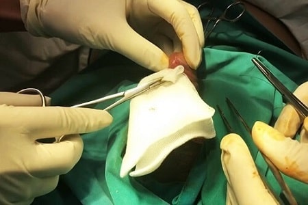 Đứt dây hãm bao quy đầu tự lành được không?