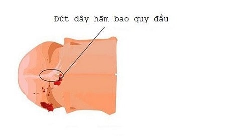 Đứt dây hãm bao quy đầu là gì?