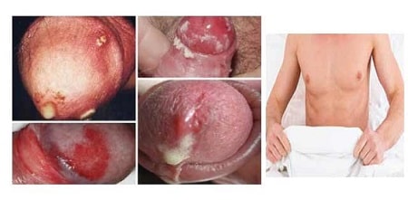 Triệu chứng nhận biết bệnh lậu cần chú ý