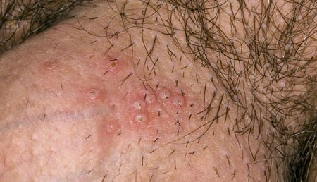 Mụn rộp sinh dục có tự khỏi ?