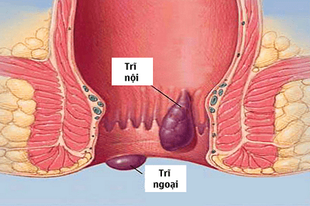 Lưu ý khi sử dụng thuốc nam trị bệnh trĩ ngoại