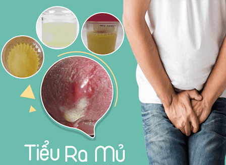 Tiểu ra mủ