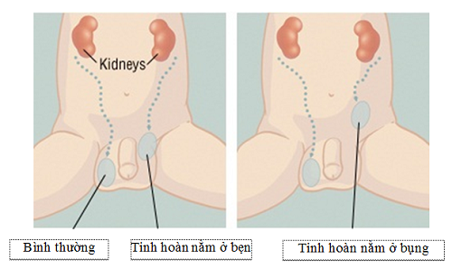 Tinh hoàn không xuống hết bìu