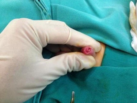 Trẻ bị viêm bao quy đầu có mủ nguy hiểm như thế nào nếu không điều trị sớm