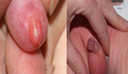 Trẻ bị viêm bao quy đầu có mủ nguyên nhân do đâu ?