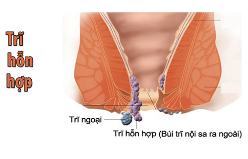 Trĩ hỗn hợp là căn bệnh rất nguy hiểm