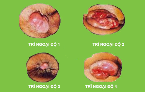 Bệnh trĩ ngoại độ 4