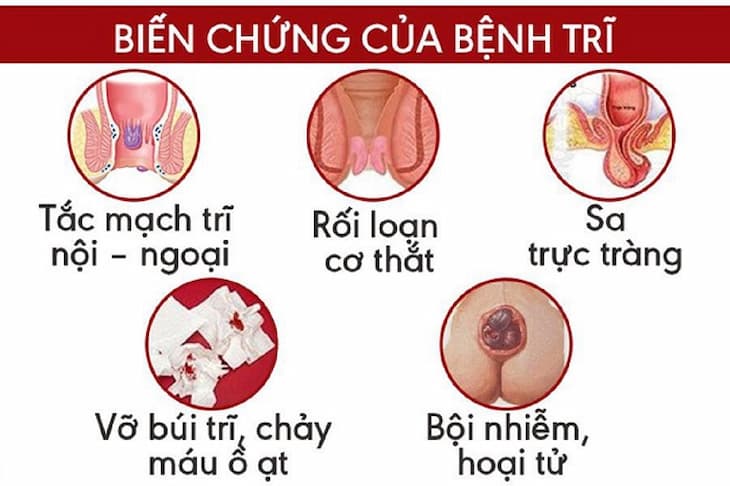 Bị bệnh trĩ nội có nguy hiểm không ?