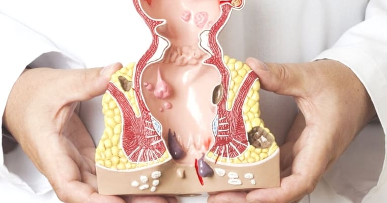Sơ lược về bệnh lý trĩ nội