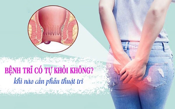 Liệu bệnh lý trĩ nội có tự hết không?