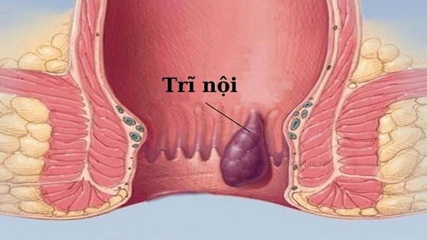 Tìm hiểu chi tiết về bệnh lý trĩ nội