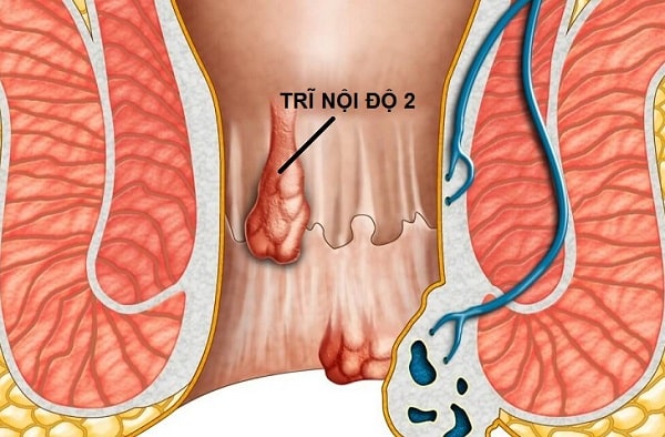 Bạn đã hiểu đúng về trĩ nội độ 2 chưa ?