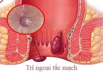 Hiểu đúng về trĩ nội tắc mạch