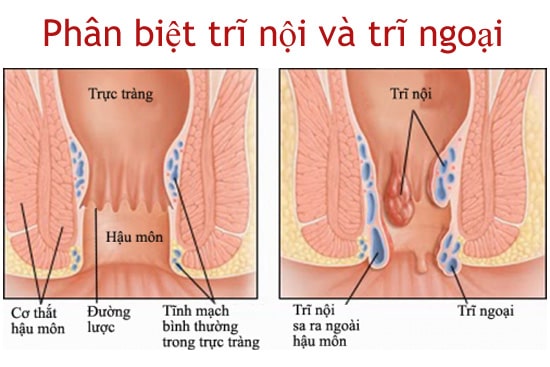 Trĩ nội trĩ ngoại khác nhau như thế nào?