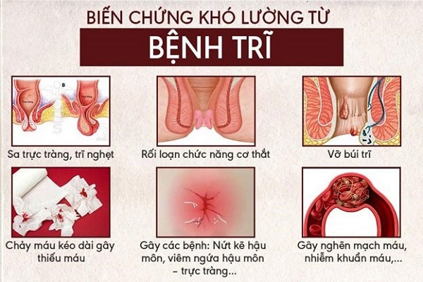 Trĩ nội và trĩ ngoại cái nào nguy hiểm hơn?