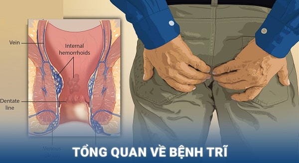 Tổng quan bệnh trĩ là gì ?