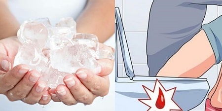 Cách chữa bệnh trĩ ngoại giai đoạn đầu tại nhà