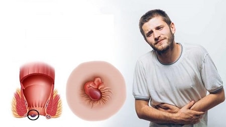 Nhận biết các triệu chứng bệnh trĩ ngoại nhẹ 