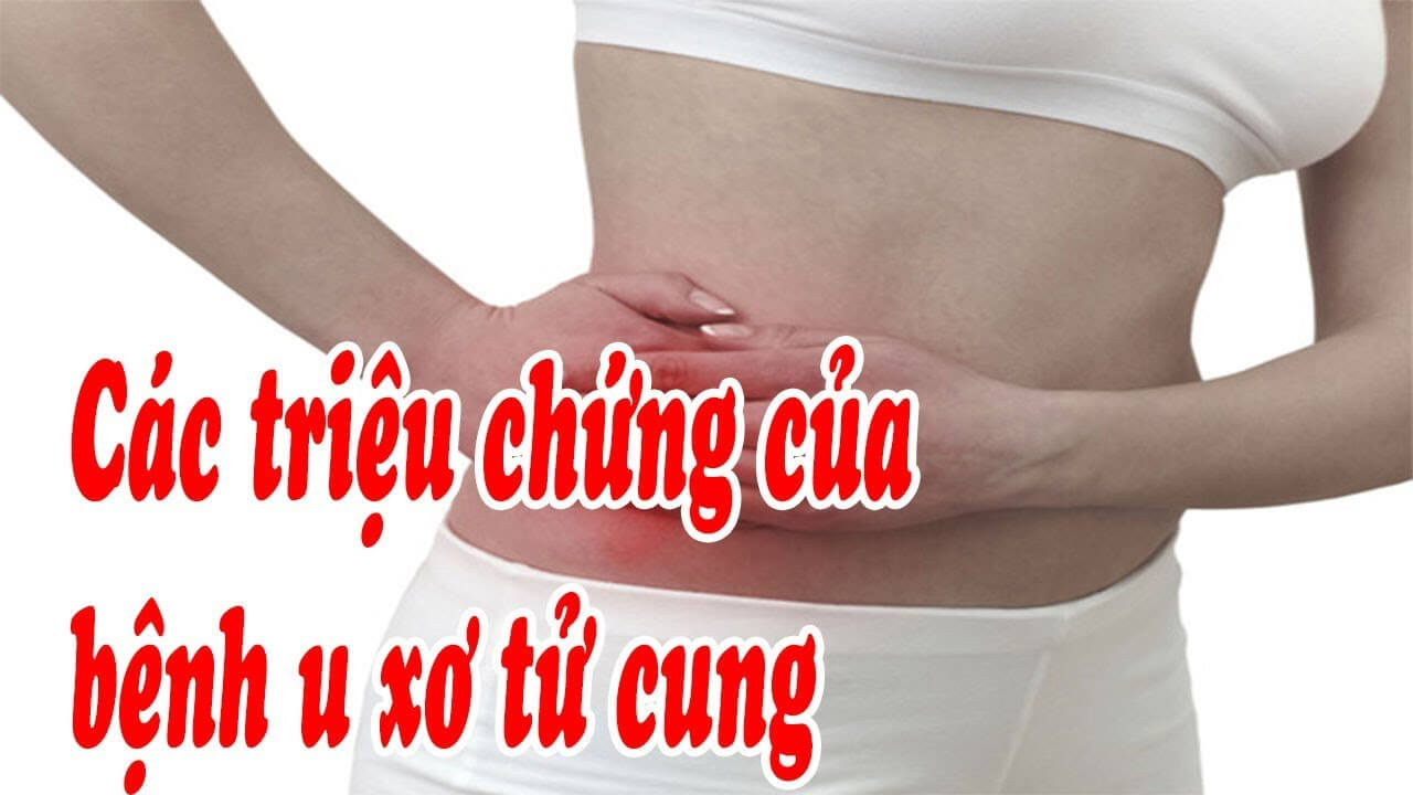 Triệu chứng bệnh u xơ tử cung