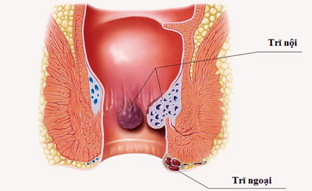 Các triệu chứng của bệnh trĩ ngoại dễ nhận biết