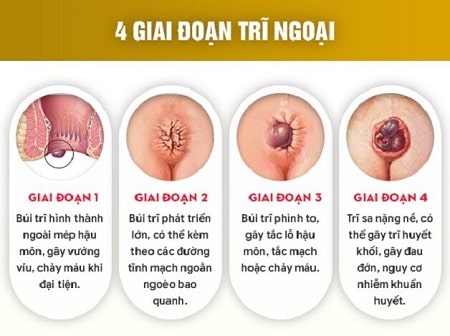 Triệu chứng của bệnh trĩ ngoại có nguy hiểm không ?