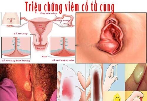Triệu chứng nhận biết viêm cổ tử cung