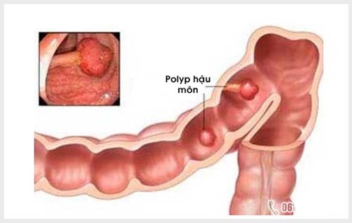 triệu chứng polyp hậu môn