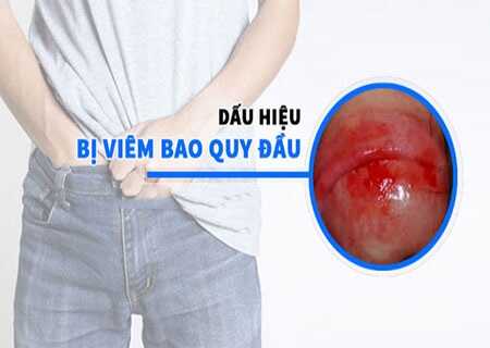 Triệu chứng bệnh viêm bao quy đầu