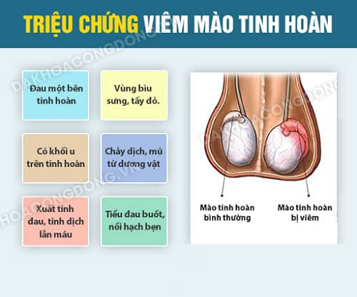 Các biểu hiện viêm mào tinh hoàn