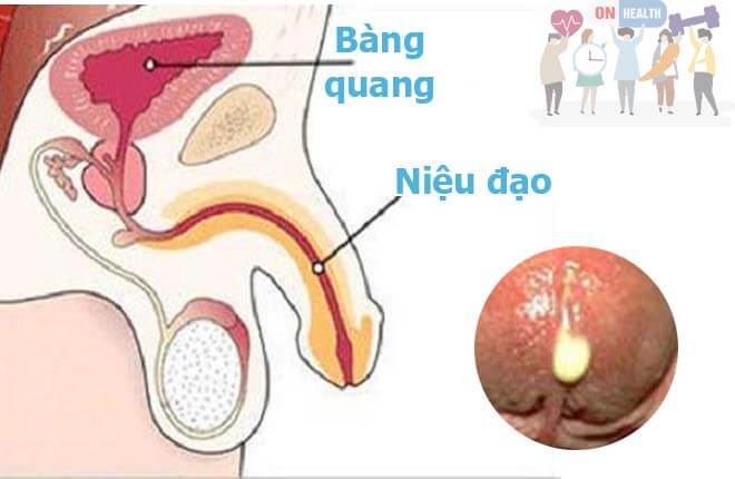 Niệu đạo xuất hiện mủ màu trắng đục