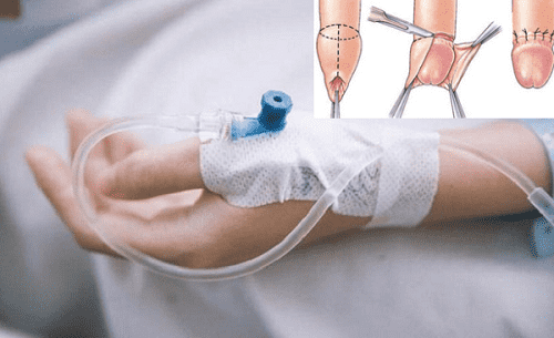 Sau cắt bao quy đầu, rất hiếm trường hợp phải truyền dịch