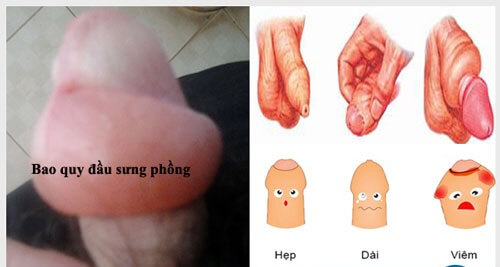 Tuột bao quy đầu bị sưng phồng– Dấu hiệu dài hẹp bao quy đầu