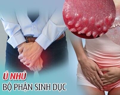 Hình ảnh u nhú sinh dục ở nữ và nam giới