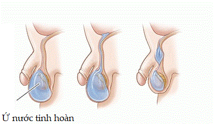Ứ nước tinh hoàn