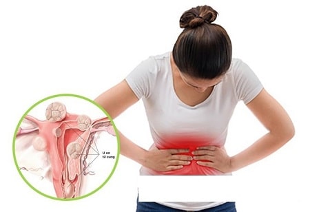 Phải làm gì để hạn chế các biến chứng u xơ tử cung? 