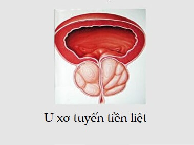  U xơ tuyến tiền liệt