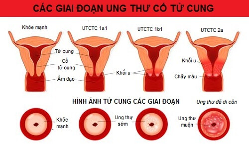 ung thư cổ tử cung theo từng giai đoạn