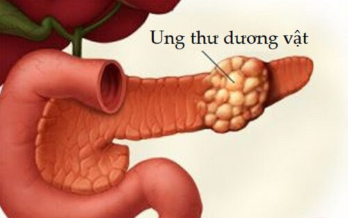 Sùi mào gà ở nam giới gây ung thư dương vật 