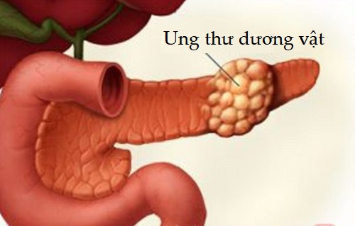 Không chữa sùi mào gà giai đoạn đầu, để lâu sẽ dẫn tới bệnh ung thư dương vật ở nam giới