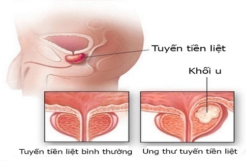 Hình ảnh ung thư tiền liệt tuyến
