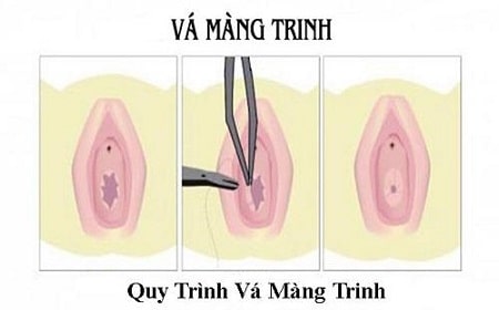 Vá màng trinh là gì và được thực hiện như thế nào?