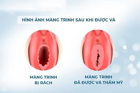 Vá màng trinh có ảnh hưởng gì không ?
