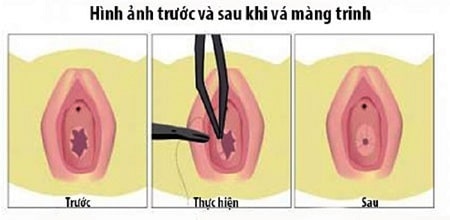 Những lưu ý trước khi vá màng trinh