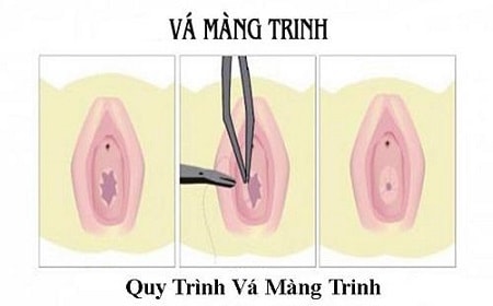 Quy trình thực hiện vá màng trinh diễn ra như thế nào?
