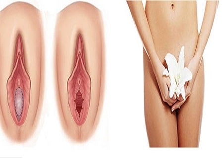 Vá màng trinh khi quan hệ ra máu không?