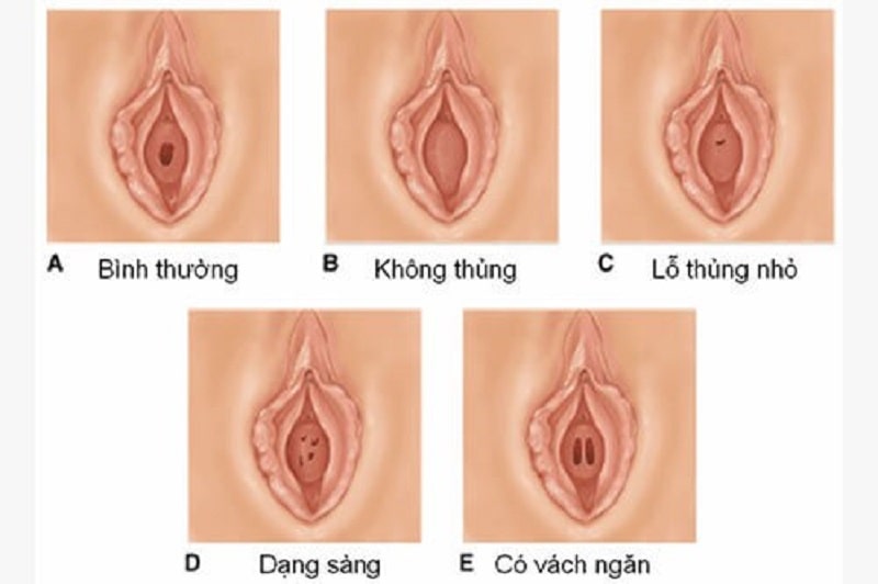 Cấu tạo vá màng trinh ở phái đẹp