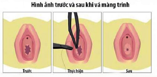 Vá màng trinh