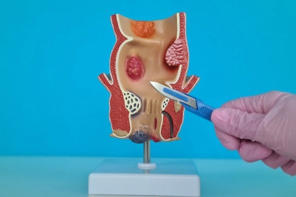 Mổ rò hậu môn cần được thực hiện khi nào?
